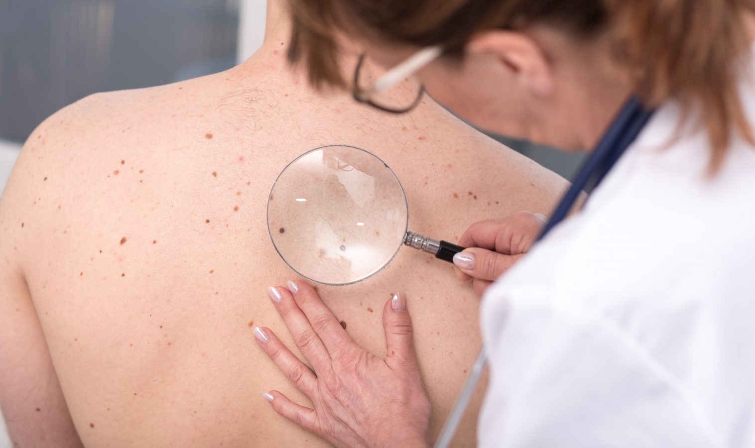Skin Cancer check and treatment